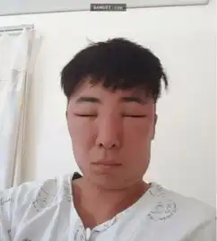 韩国男子因染发过敏导致整张脸都肿起来,五官大变形却还是每天自拍给大家看小刚是你