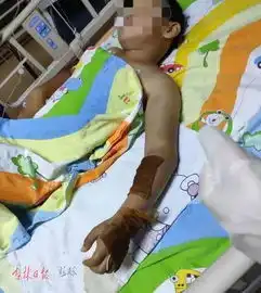 惨9岁男孩被毒蛇咬伤,左手左臂变成紫黑色来长春医治后...