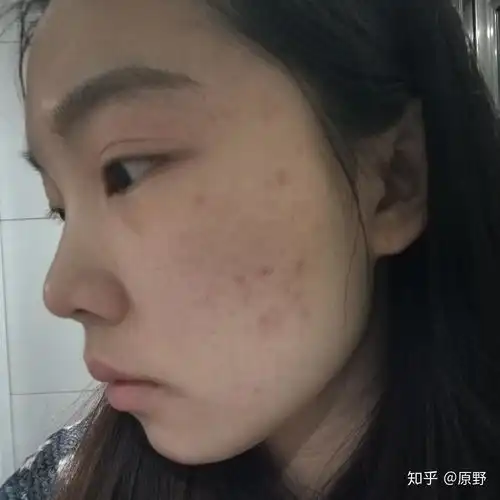 一组图片链接激光祛痘
