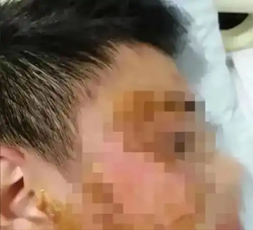 13岁男孩被8名同学霸凌,他们往他身上淋了11盆开水,9天后才被发现