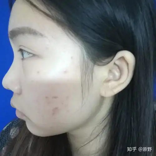 一组图片链接激光祛痘