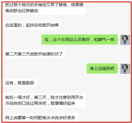 当心湖口9岁男孩被隐翅虫咬伤,千万不能直接拍死它否则....
