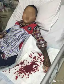 漳州9岁男孩误把路边眼镜蛇当玩具蛇手被咬伤