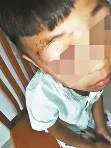 男孩被狗咬后去世专家疫苗只能降低发病率