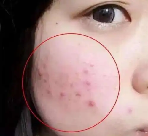 长了螨虫的皮肤是什么样的图片